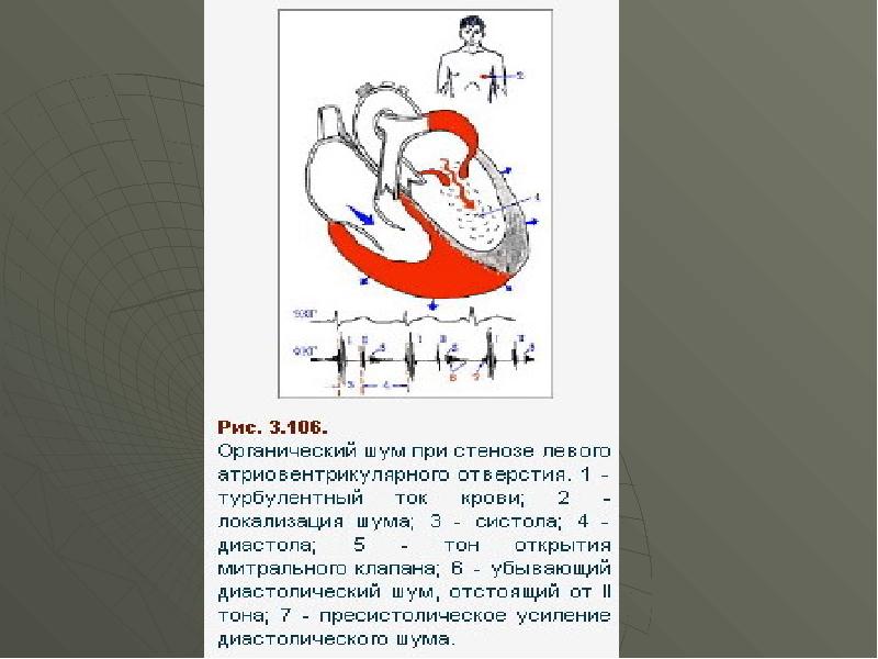 Ревматизм и пороки сердца презентация