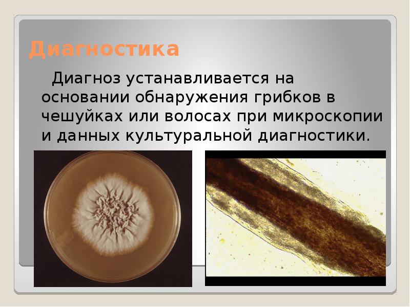 Диагностика
Диагноз устанавливается на основании обнаружения грибков в чешуйках Диагностика
Диагноз устанавливается на основании обнаружения грибков в чешуйках
