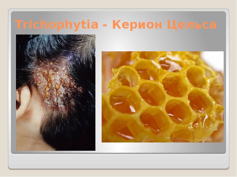 Trichophytia - Керион Цельса Trichophytia - Керион Цельса