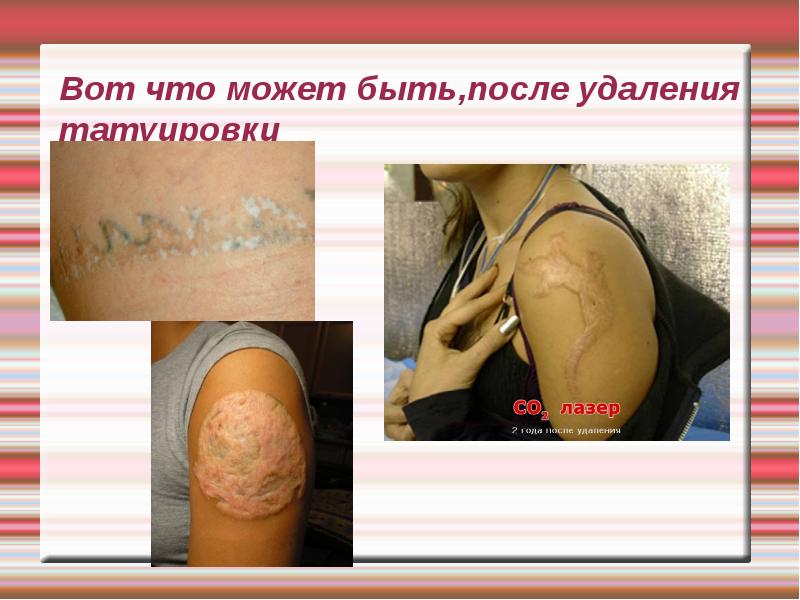 Вот что может быть,после удаления татуировки