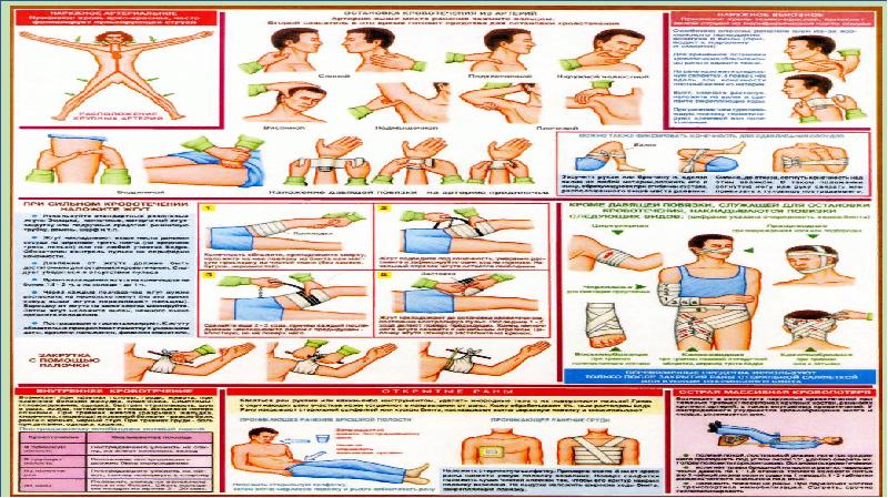 Виды кровотечений способы остановки кровотечений презентация