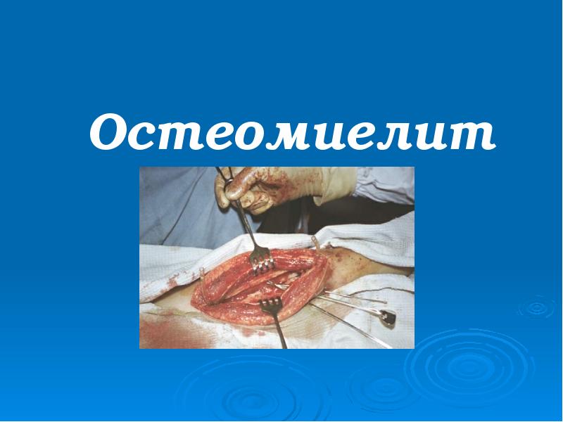 Остеомиелит Остеомиелит