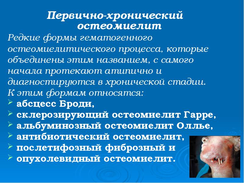 Первично-хронический остеомиелит
Первично-хронический остеомиелит
Редкие формы гематогенного
остеомиелитического процесса, которые
Первично-хронический остеомиелит
Первично-хронический остеомиелит
Редкие формы гематогенного
остеомиелитического процесса, которые