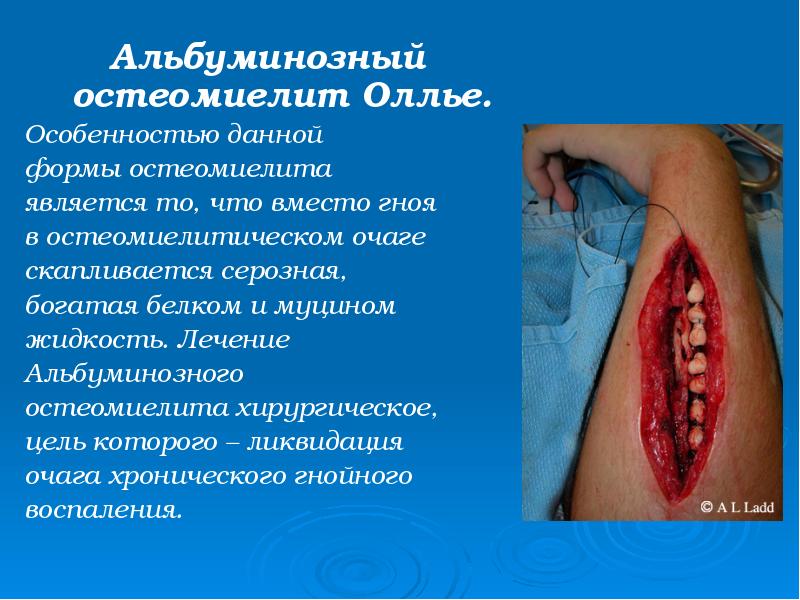 Альбуминозный остеомиелит Оллье.
Альбуминозный остеомиелит Оллье.
Особенностью данной
формы остеомиелита
является Альбуминозный остеомиелит Оллье.
Альбуминозный остеомиелит Оллье.
Особенностью данной
формы остеомиелита
является