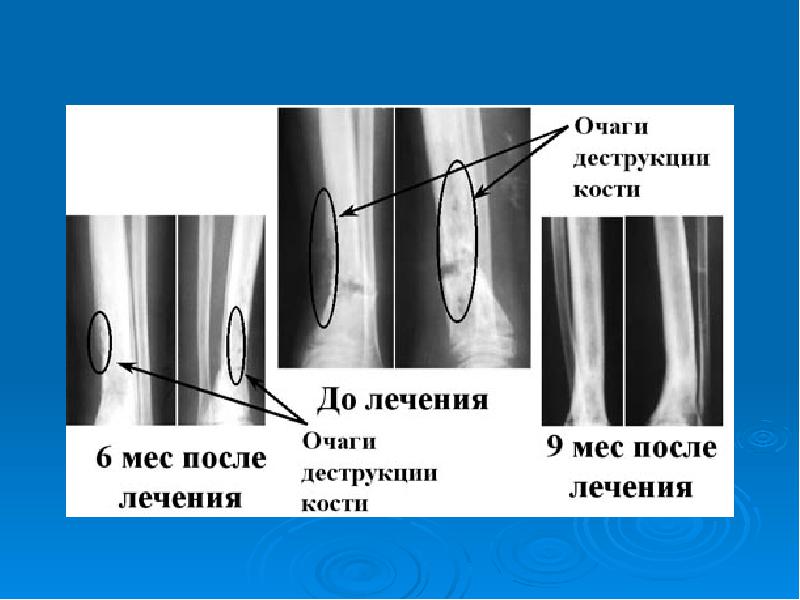 Лечение остеомиелита презентация