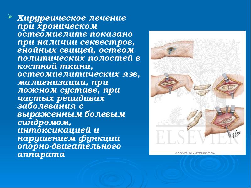 Хирургическое лечение при хроническом остеомиелите показано при наличии секвестров, гнойных свищей, Хирургическое лечение при хроническом остеомиелите показано при наличии секвестров, гнойных свищей,