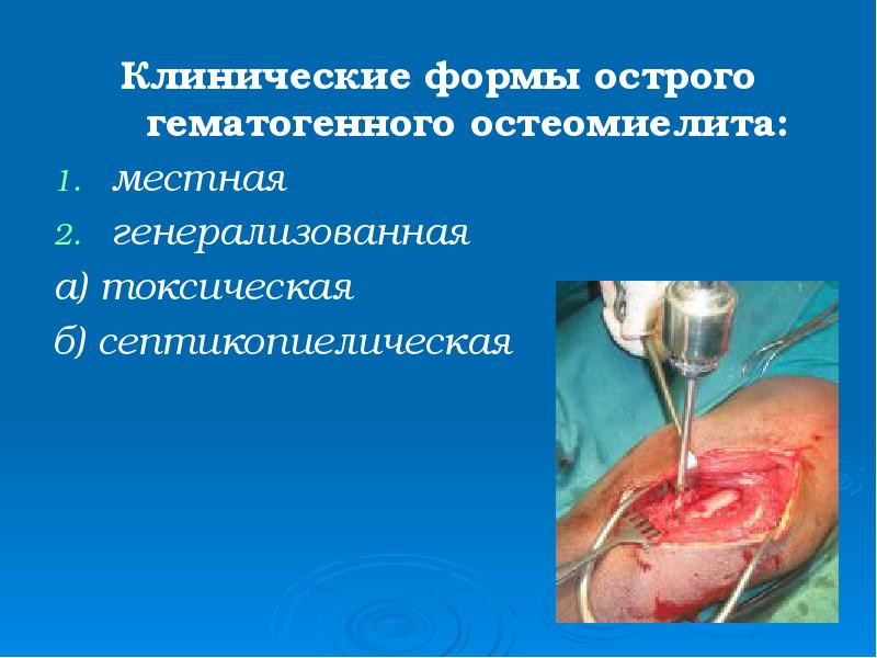 Клинические формы острого гематогенного остеомиелита:
Клинические формы острого гематогенного остеомиелита:
местная
Клинические формы острого гематогенного остеомиелита:
Клинические формы острого гематогенного остеомиелита:
местная
