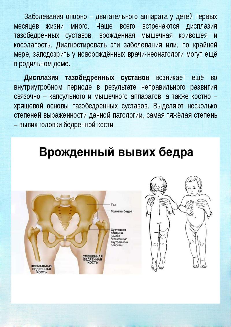 Врожденные вывихи бедра презентация