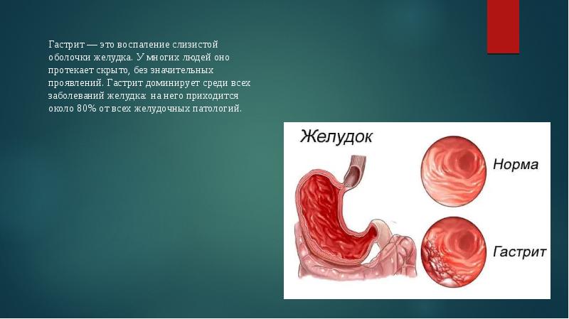 Профилактика гастрита презентация