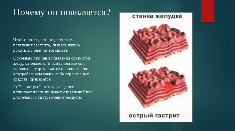 Презентация на тему гастрит