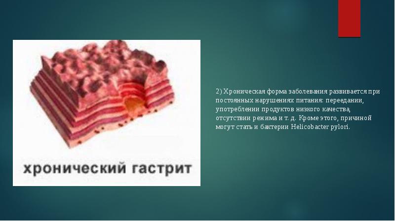 Презентация по гастриту