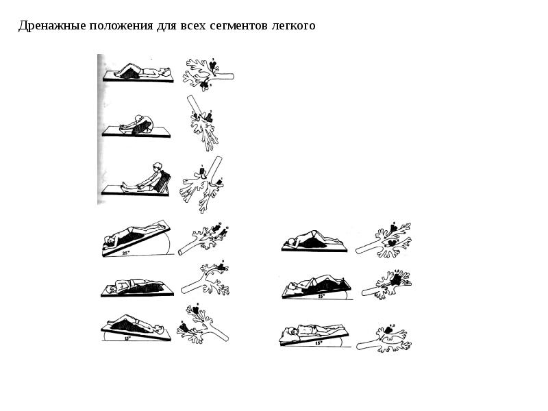 Дренажное положение. Дренажное положение Квинке. Дренажные положения для отхождения мокроты. Дренажное положение при бронхите. Дренажное положение при пневмонии.