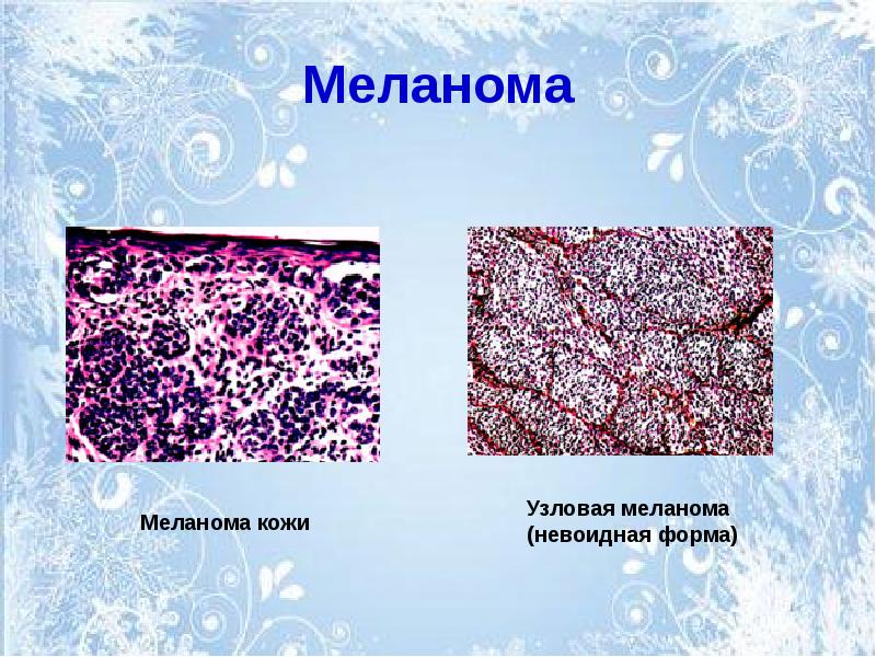 Опухоли меланинобразующей ткани презентация