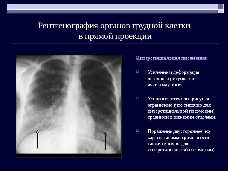 Легочный рисунок усилен за счет интерстициального компонента