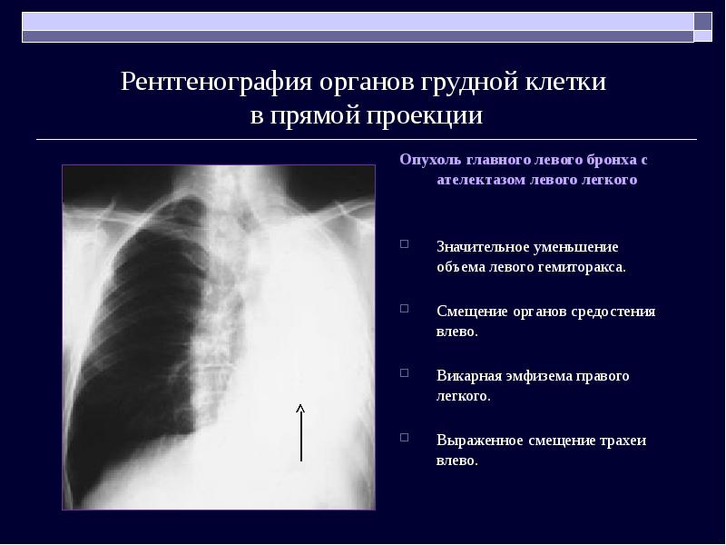 На рентгенологической картине напряженного пиопневмоторакса отмечается смещение средостения в