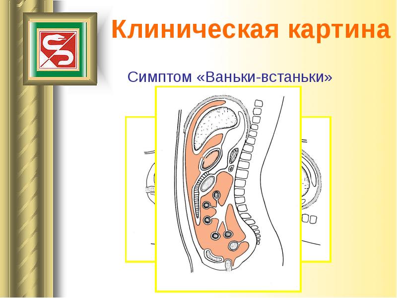 Перфоративная язва презентация