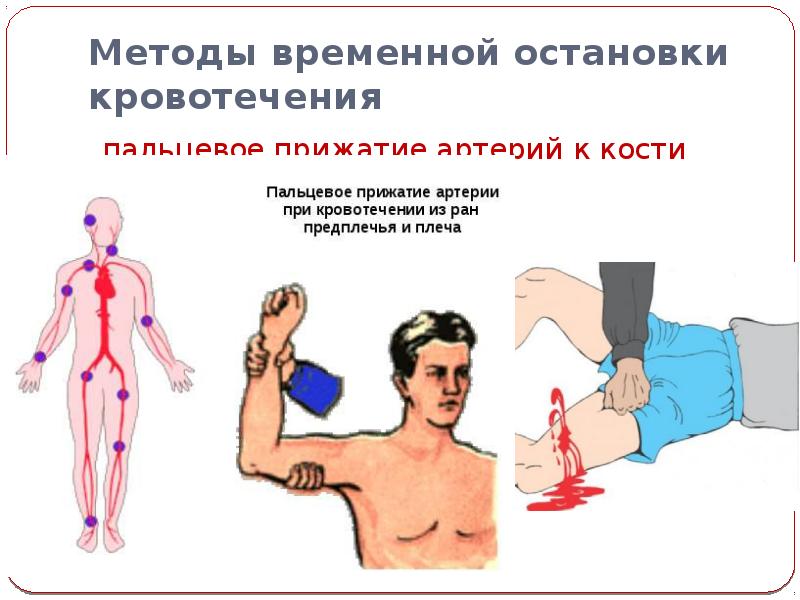 Какие способы остановки кровотечения. Метод временной остановки кровотечения - пальцевого прижатия. Способы остановки кровотечения пальцевое прижатие. Способы остановки крови. Презентация на тему остановка кровотечения.