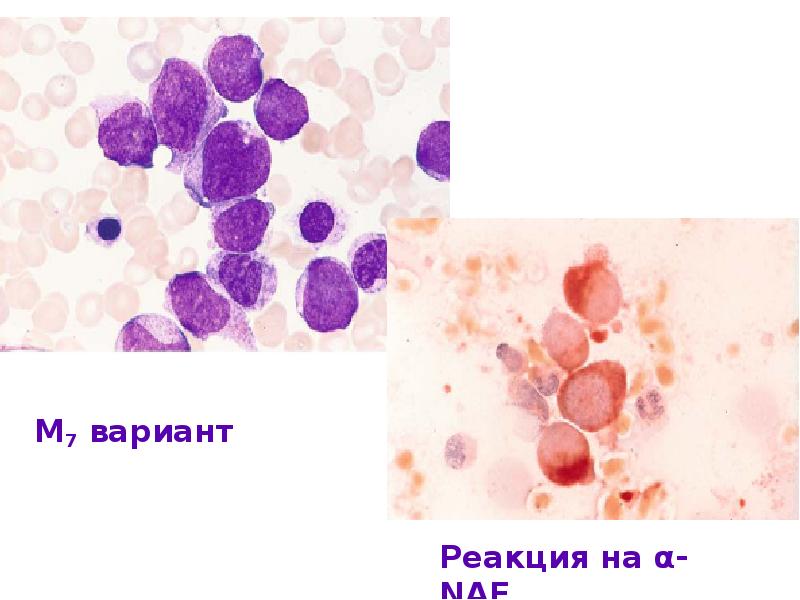 Лейкоз у детей презентация