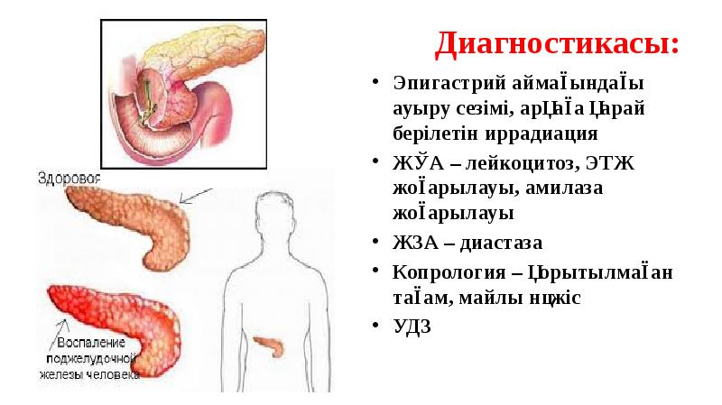 Диагностикасы:
Эпигастрий аймағындағы ауыру сезімі, арқаға қарай берілетін иррадиация
ЖҚА – Диагностикасы:
Эпигастрий аймағындағы ауыру сезімі, арқаға қарай берілетін иррадиация
ЖҚА –