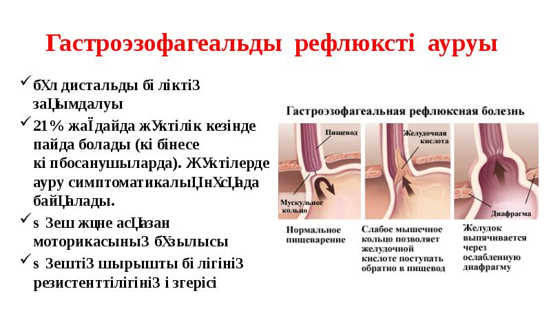 Гастроэзофагеальды рефлюксті ауруы
бұл дистальды бөліктің зақымдалуы
21% жағдайда жүктілік кезінде Гастроэзофагеальды рефлюксті ауруы
бұл дистальды бөліктің зақымдалуы
21% жағдайда жүктілік кезінде