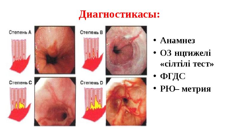 Диагностикасы:
Анамнез
Оң нәтижелі «сілтілі тест»
ФГДС
PҺ – метрия Диагностикасы:
Анамнез
Оң нәтижелі «сілтілі тест»
ФГДС
PҺ – метрия