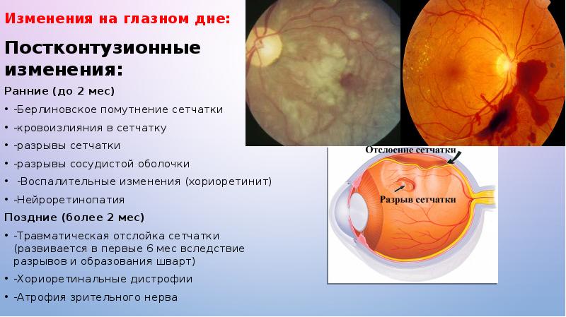 Патология сосудистой оболочки глаза презентация