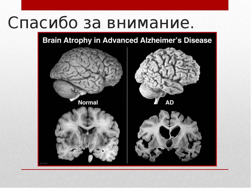 Болезнь альцгеймера презентация