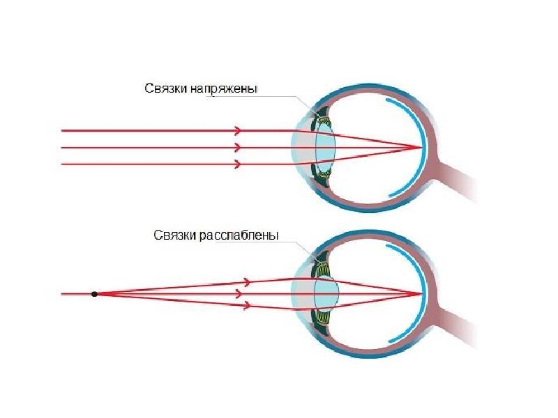 Фокусировка глаза человека. Схема аккомодации хрусталика. Аккомодация зрения схема. Структура аккомодации глаза. Аккомодация механизм в офтальмологии.