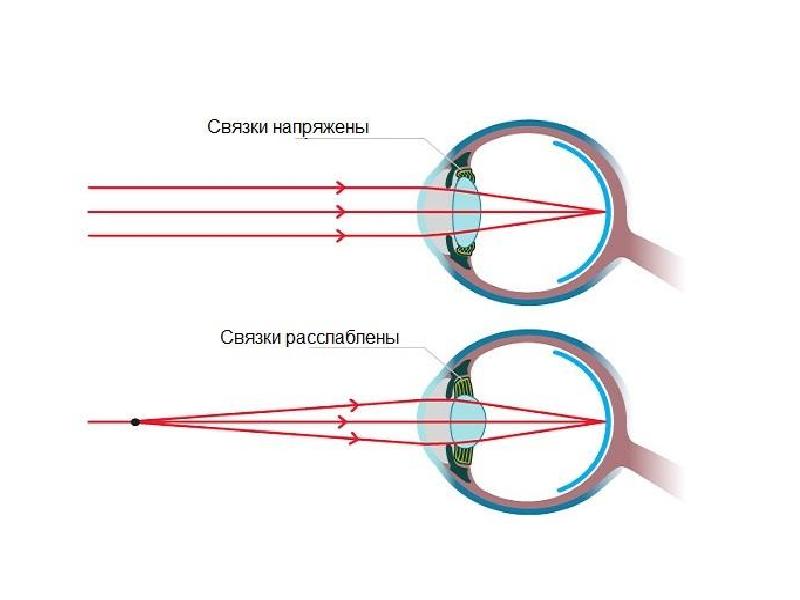 Схема преломления лучей хрусталиком глаза при рассматривании близко и далеко