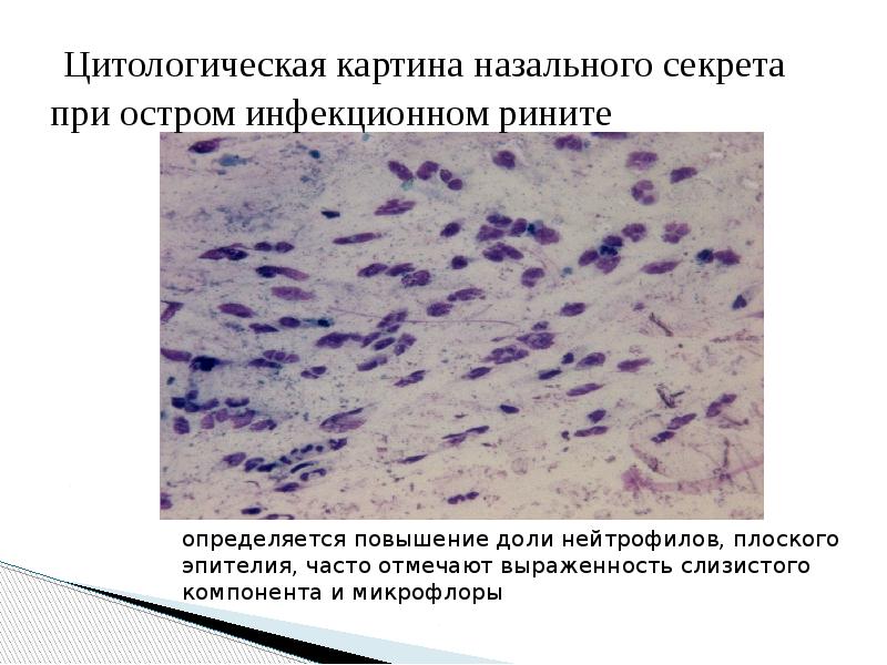Цитологическая картина назального секрета при остром инфекционном рините Цитологическая картина назального секрета при остром инфекционном рините