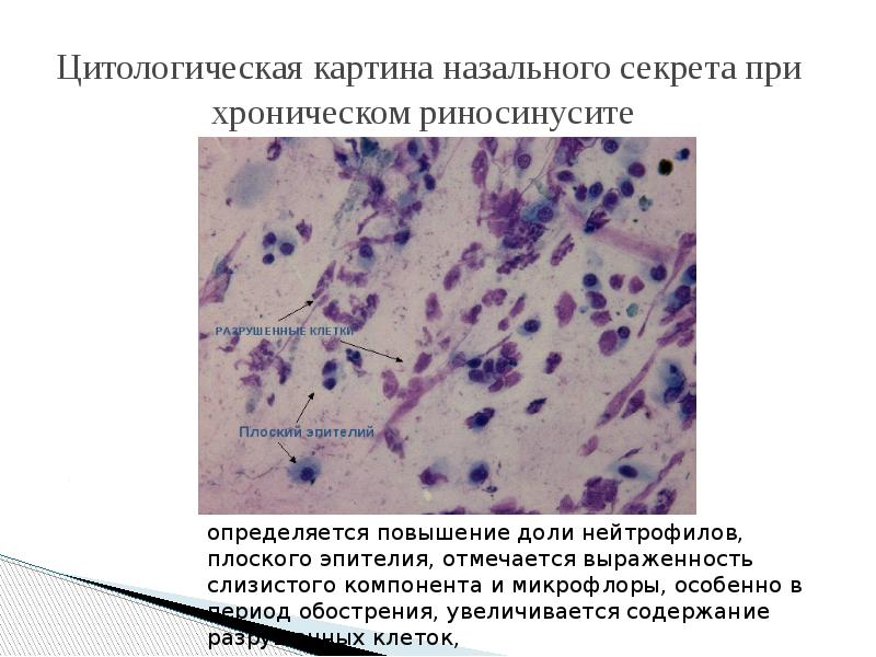 Цитологическая картина назального секрета при хроническом риносинусите Цитологическая картина назального секрета при хроническом риносинусите