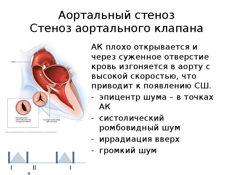 Стеноз аортального клапана. Стеноз аортального клапана клапан. При стенозе клапана аорты. Двустворчатый клапан аорты,стеноз аортального клапана. Тяжелый стеноз аортального клапана.