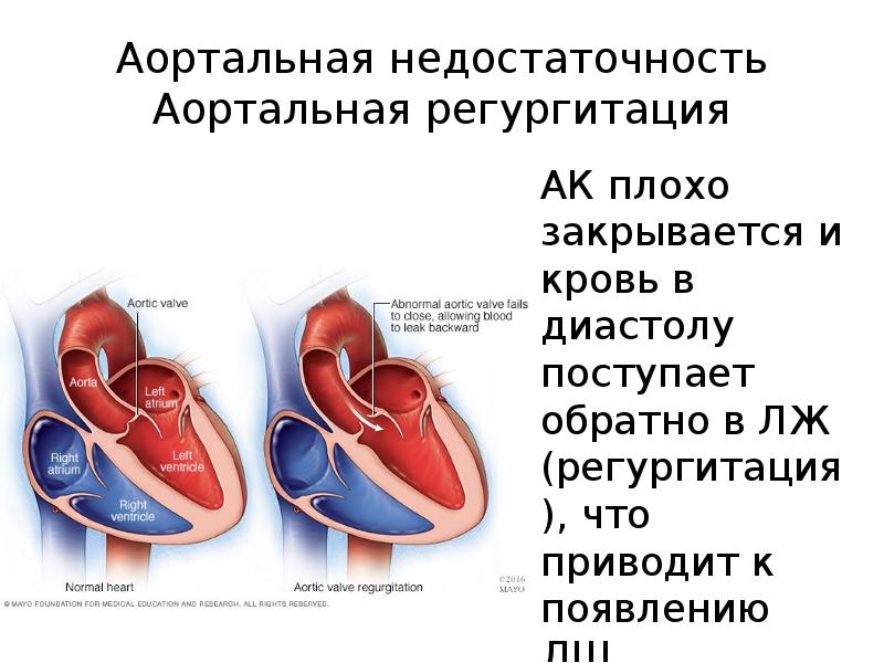 Регургитация митрального клапана. Регургитация 2 степени аортального клапана. Регургитация аортального клапана степени. Регургитация аортального клапана 1 степени. Аортального клапана с регургитацией 1-2 степени.