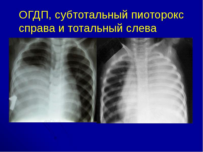 Острая деструктивная пневмония у детей презентация