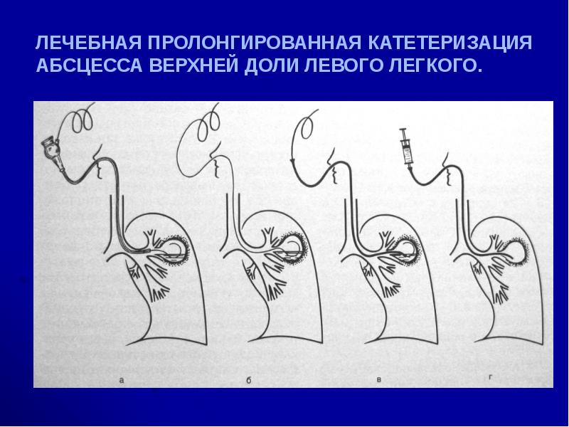 Острая гнойная деструктивная пневмония у детей презентация