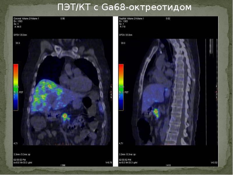 Пэт кт отзывы. ПЭТ кт доклад.