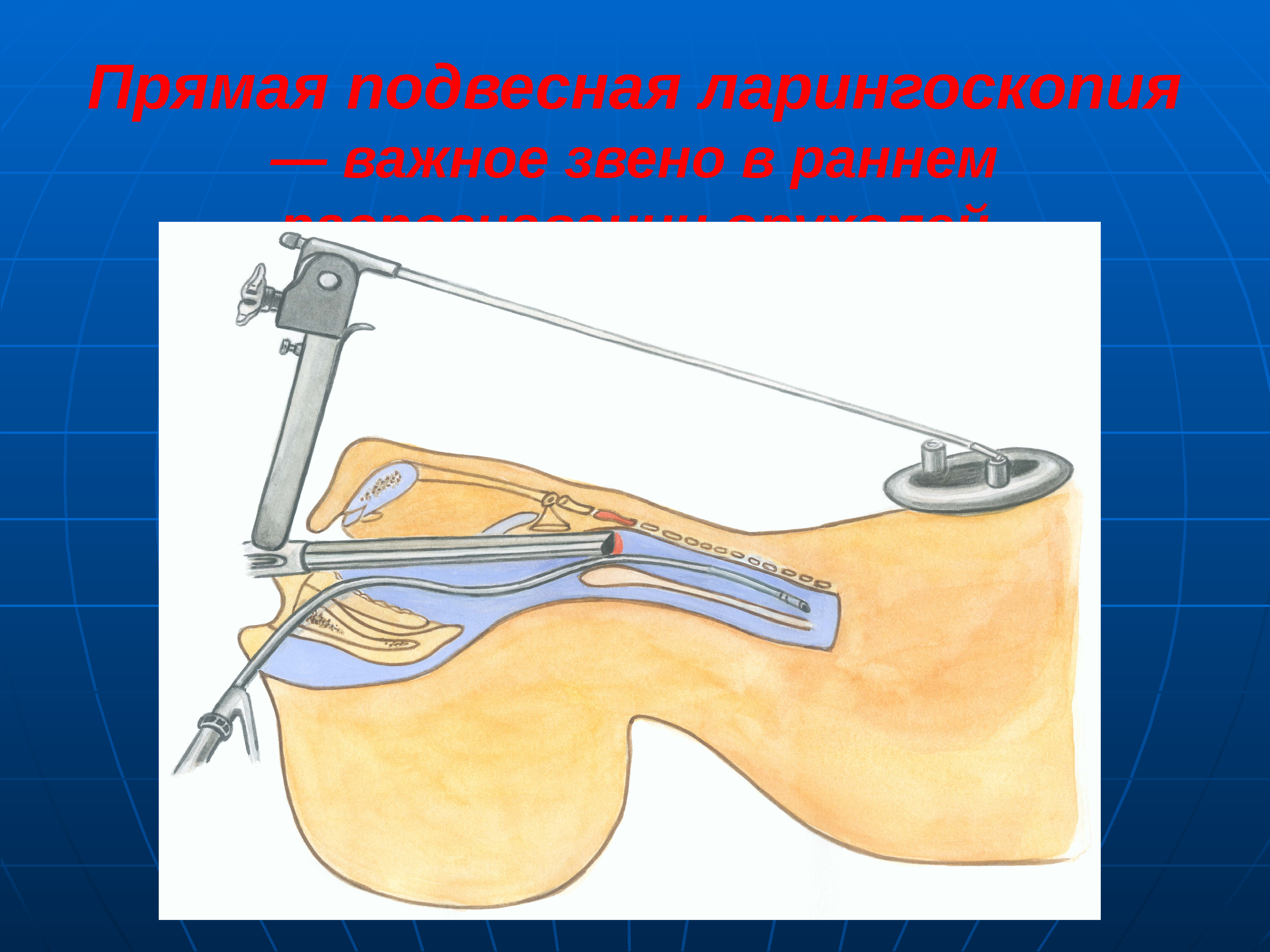 Новообразования лор органов презентация