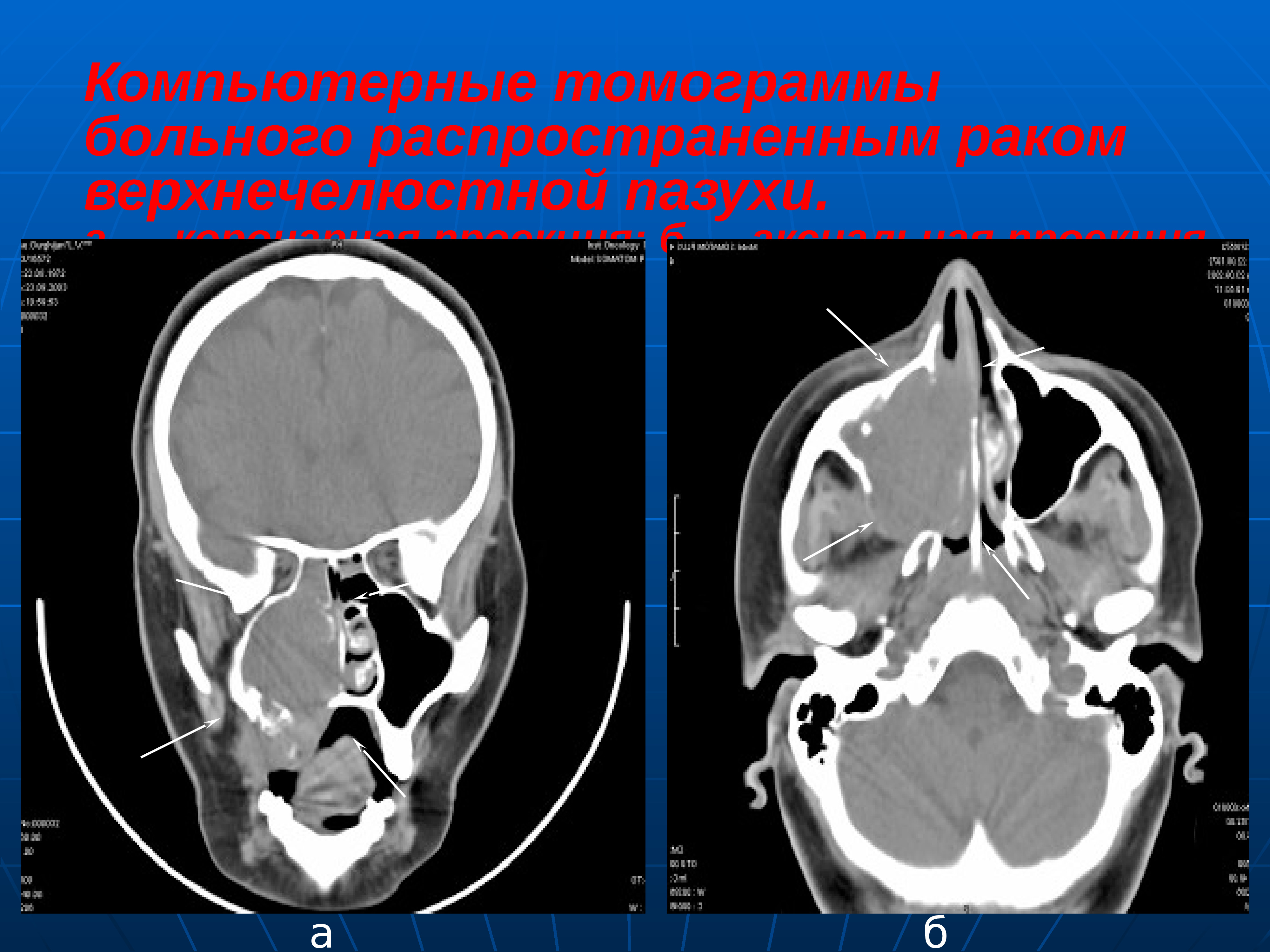 Кт пазух. Кт верхнечелюстной пазухи. Саркома верхнечелюстной пазухи кт. Коронарная проекция мрт. Опухоль лобной пазухи кт.