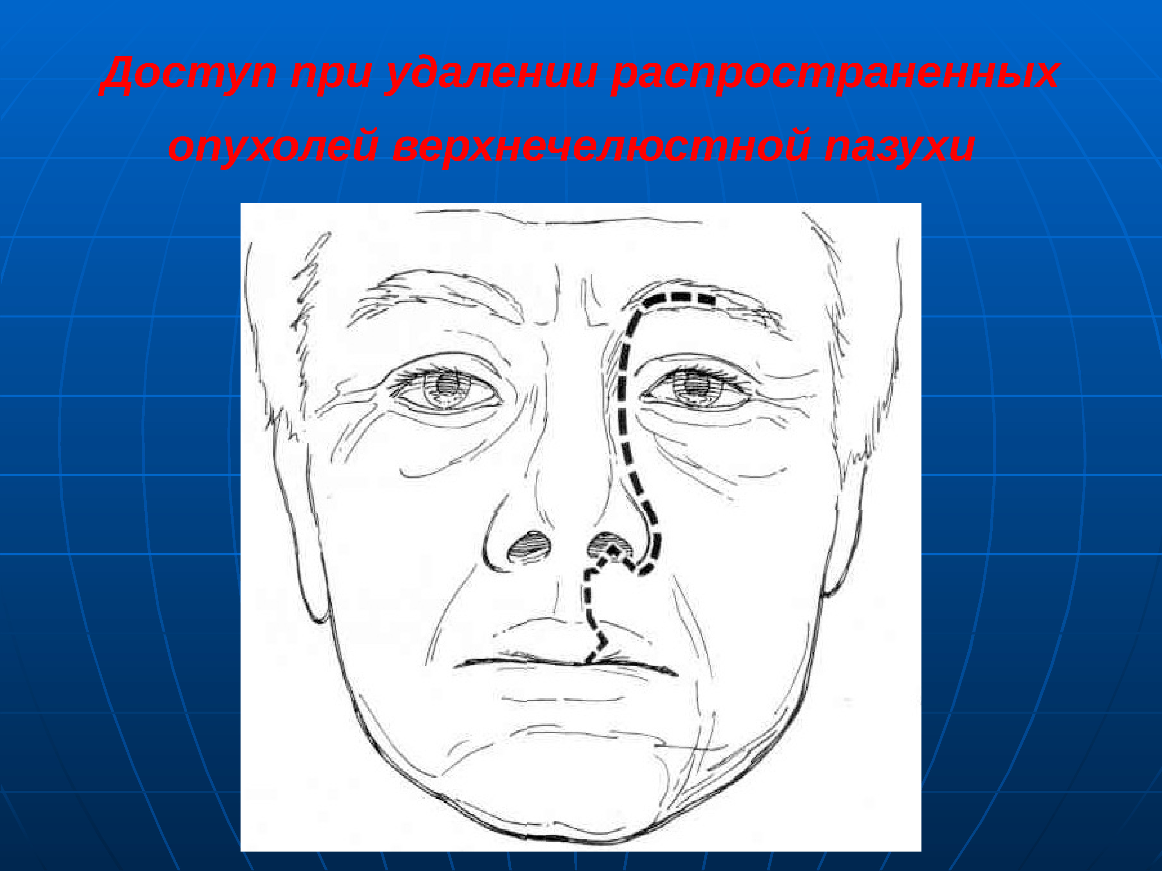 Новообразования лор органов презентация