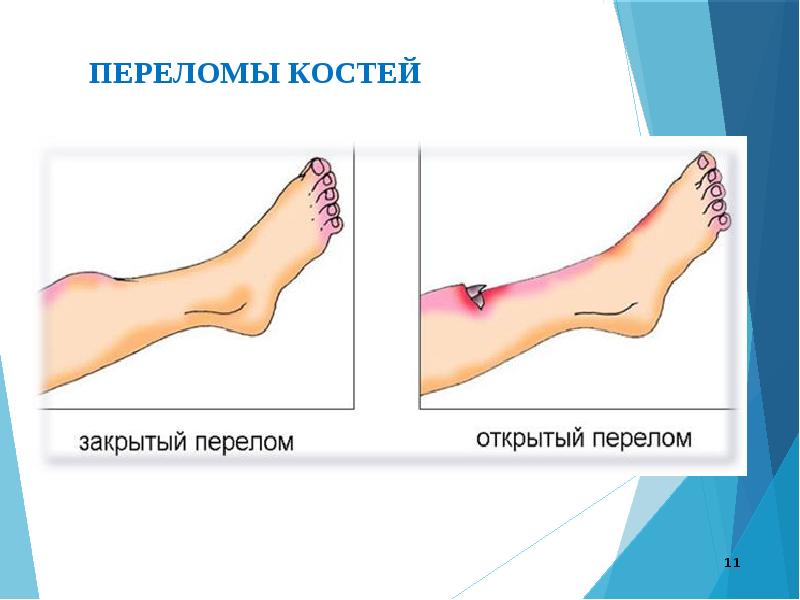 Закрытый перелом картинка