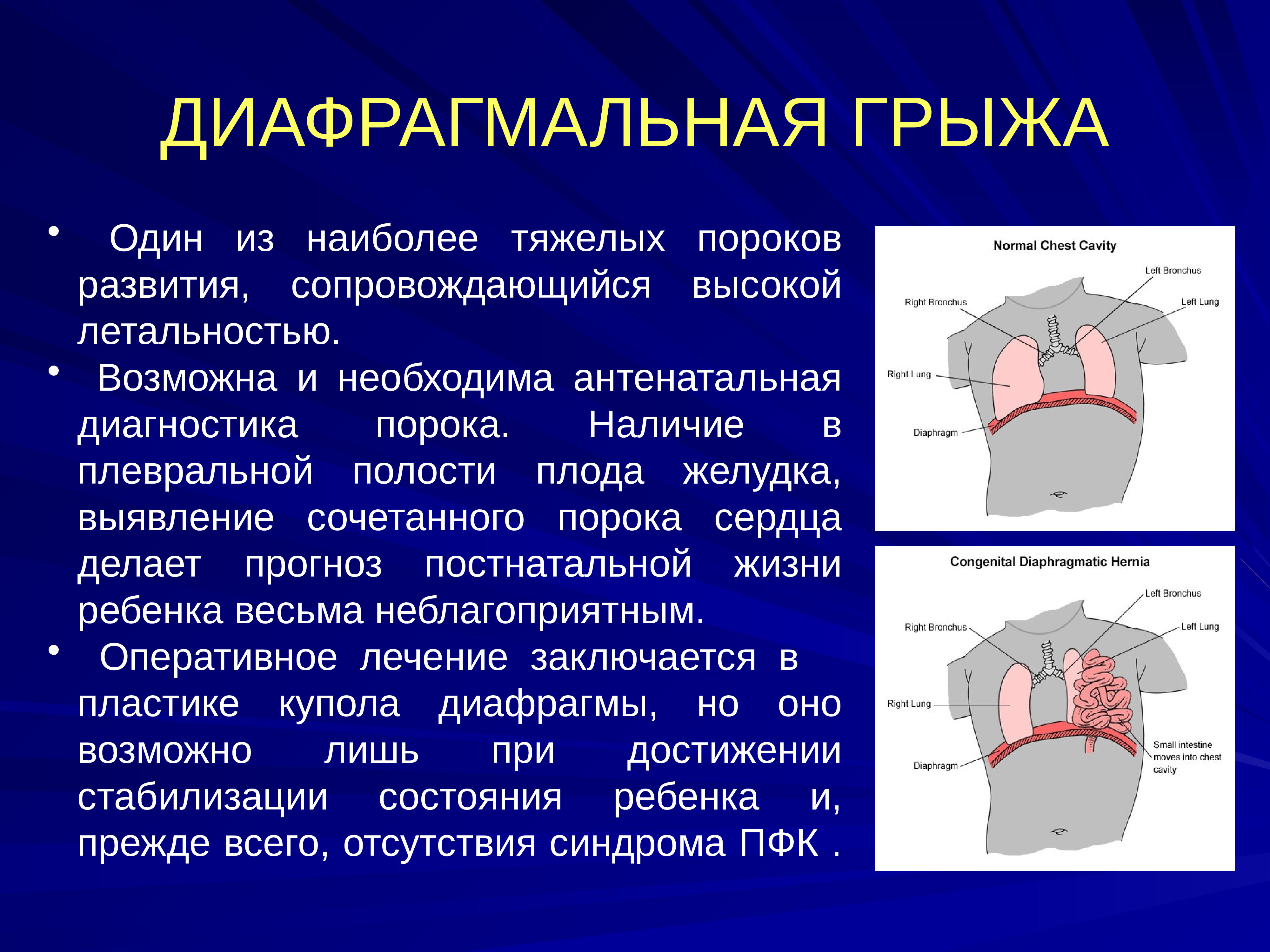 Грыжа пищевого отверстия фото