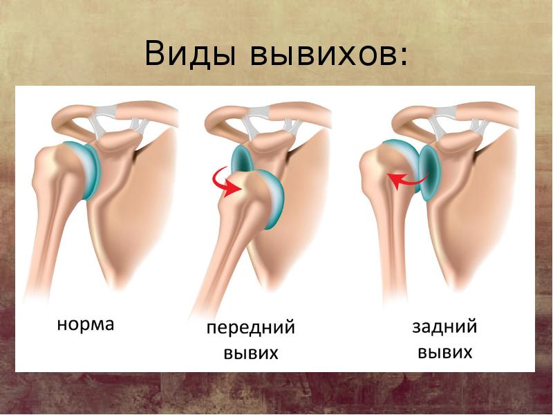 Вывих картинка для презентации