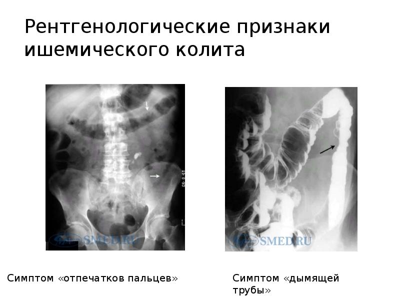 Ишемический колит презентация