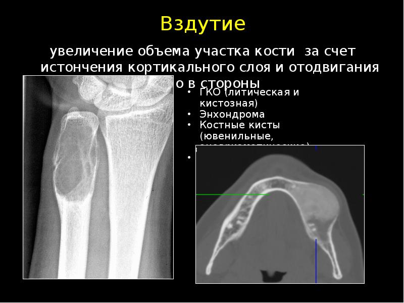 Кортикальная кость. Кортикальный слой кости. Вздутие кортикального слоя кости. Кортикальный слой бедренной кости. Истончение коркового слоя кости.