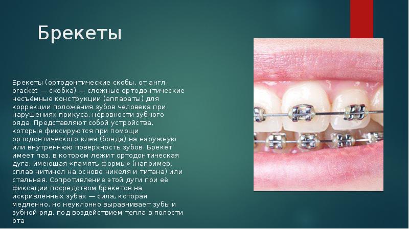 Презентация на тему брекет система