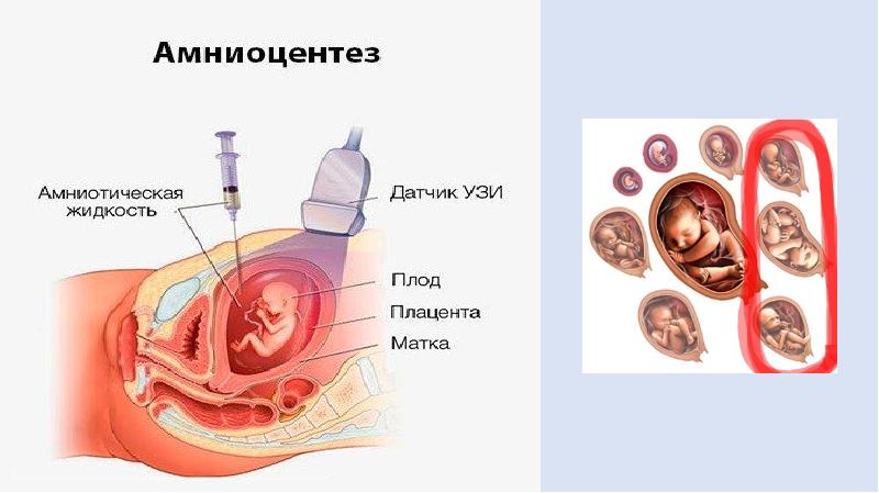 Пренатальная диагностика презентация