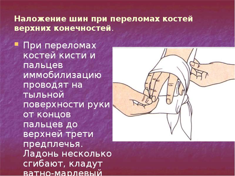 Переломы костей предплечья презентация