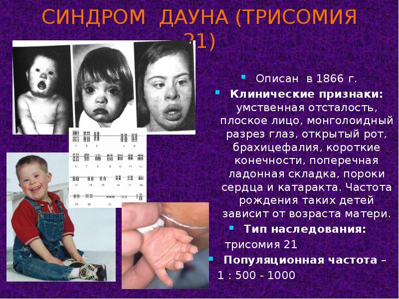 Болезнь дауна какой. Трисомии 21 (синдрома Дауна). Мозаичная трисомия синдрома Дауна. Монголоидный разрез глазных при синдроме Дауна. Синдром Дауна трисомия.