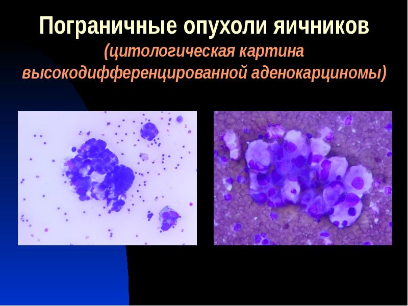 Выпотные жидкости презентация