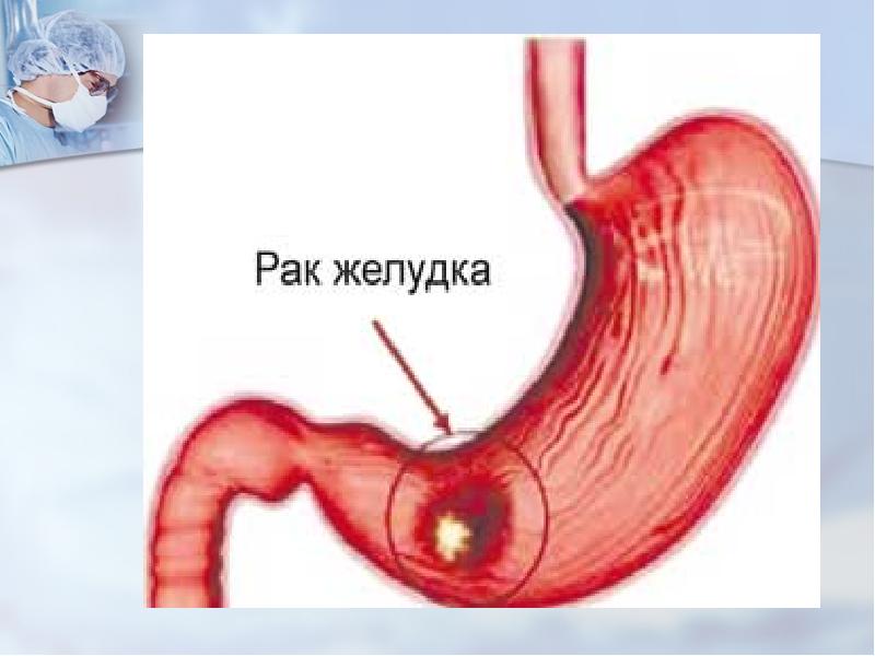 Асқазанның ойық жарасы презентация